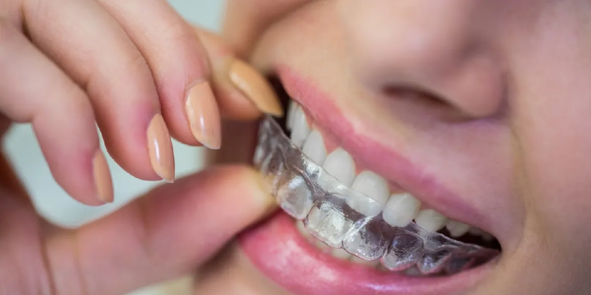 Aligners