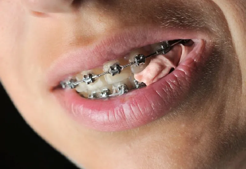7 Everyday Habits That Can Affect Your Braces or Aligner-01.webp