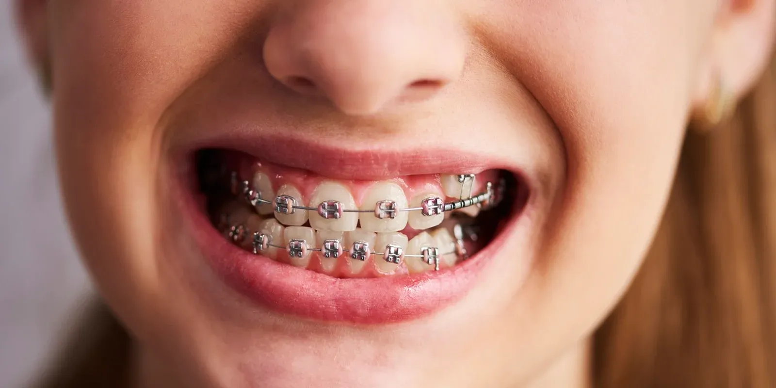 All About Braces