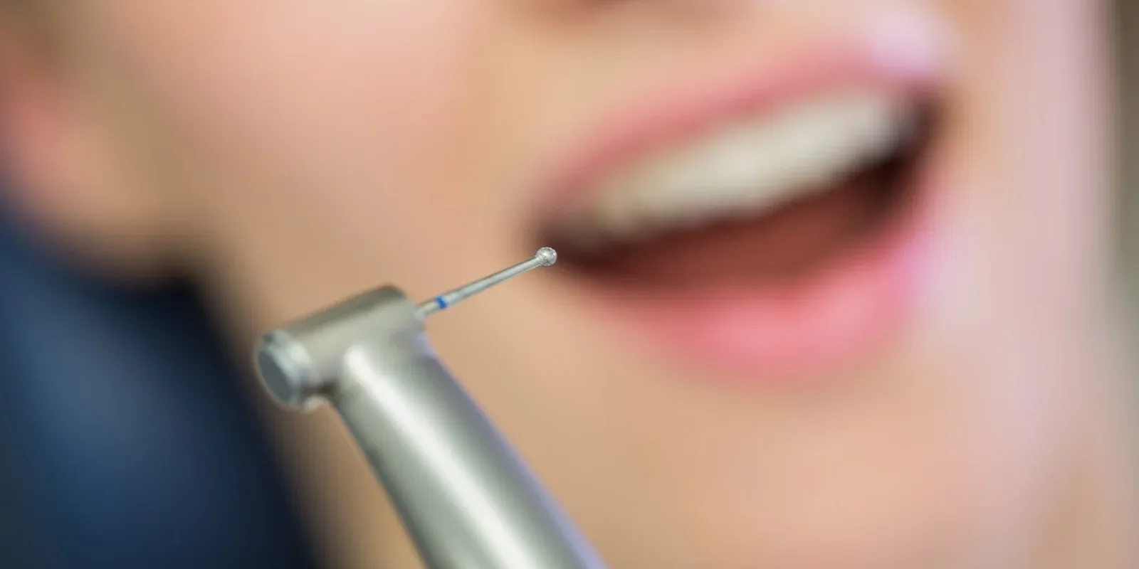 Dental Fillings: What You Need to Know
