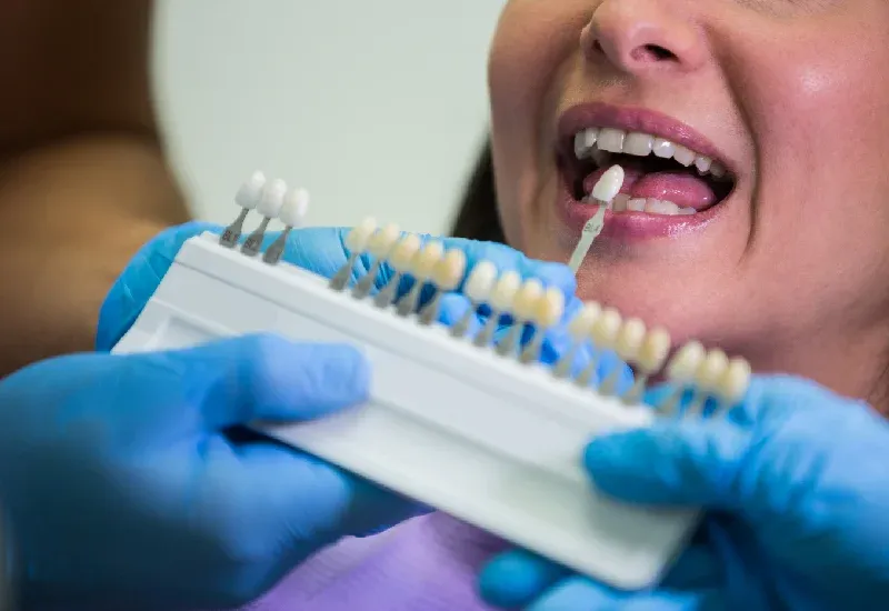 The Role of Veneeers in Smile Transformation