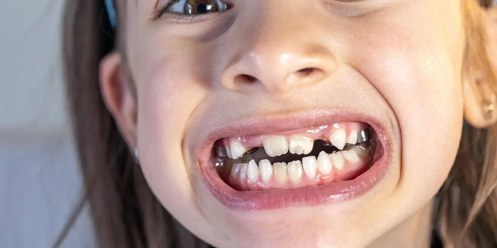 Top 3 Causes of Child Tooth Decay
