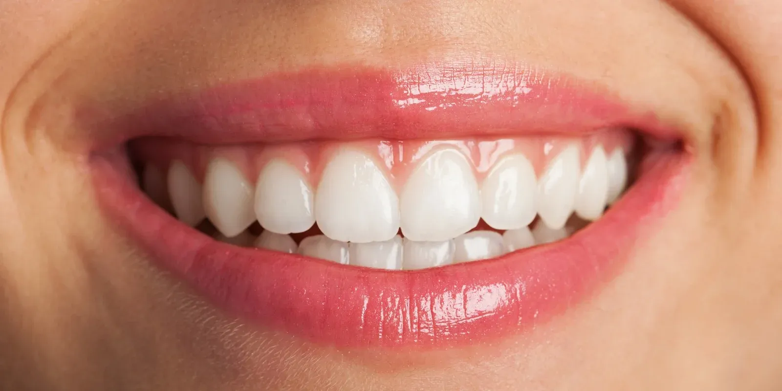 Top 5 Best Home Whitening Kits