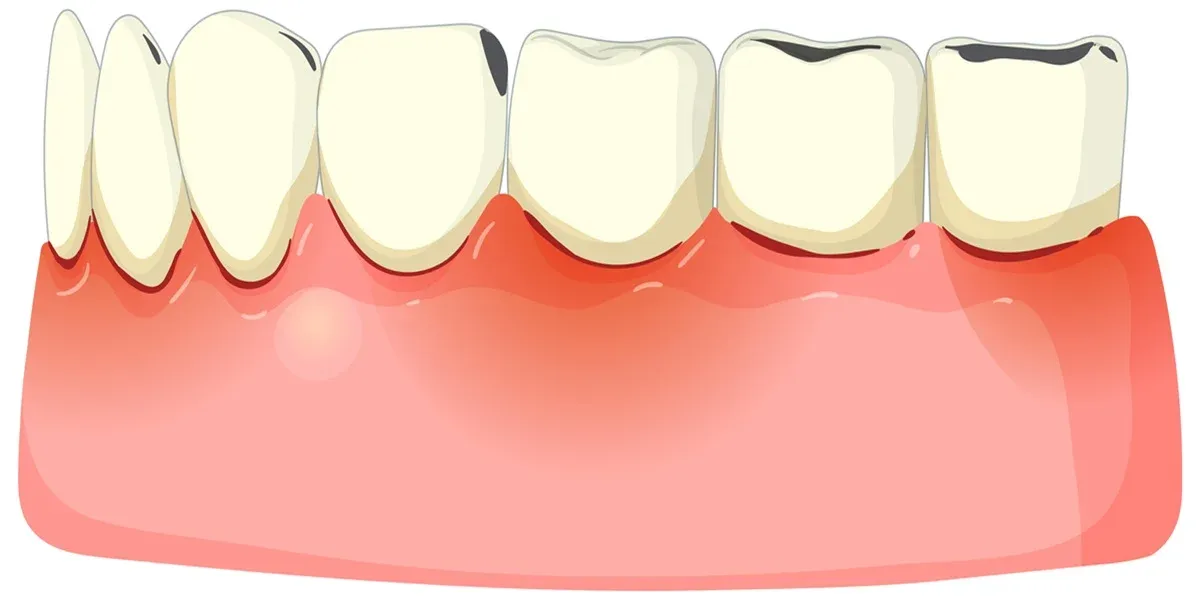 What is Periodontal Disease and How to Prevent it?