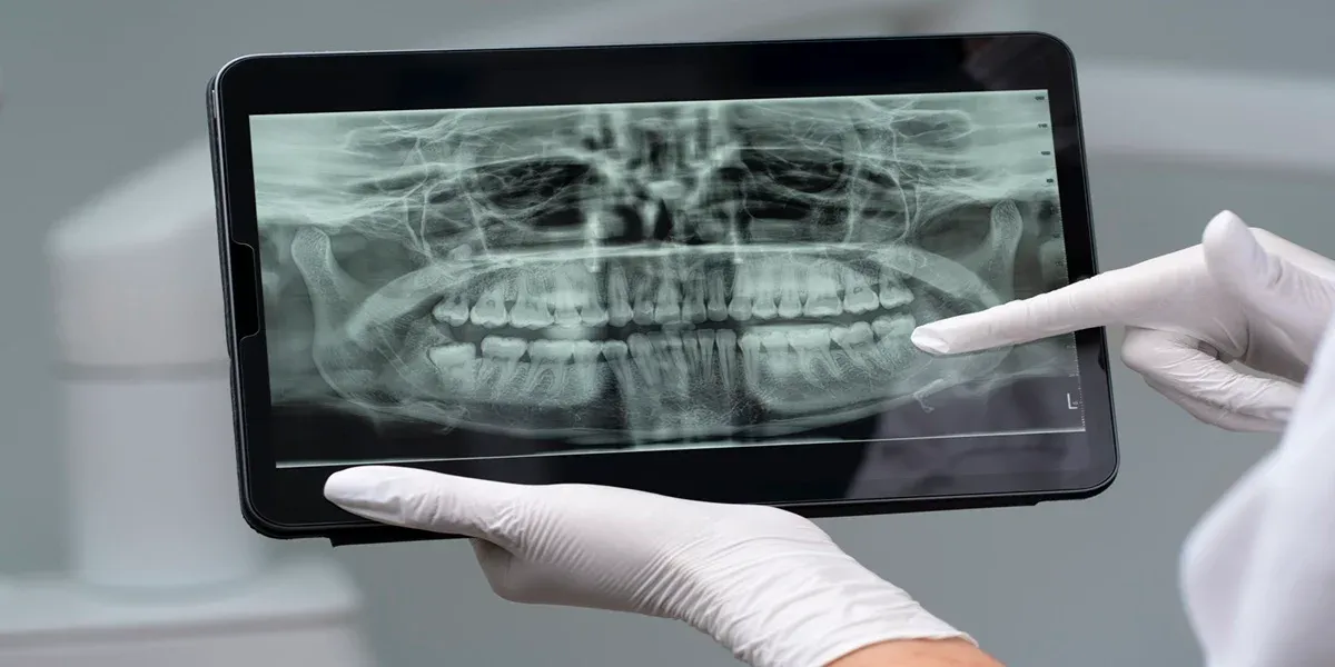 Why Do I Need Dental X-Rays?
