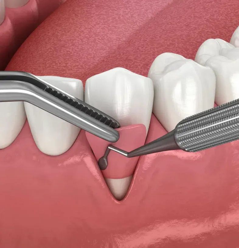 Dental Crown Types